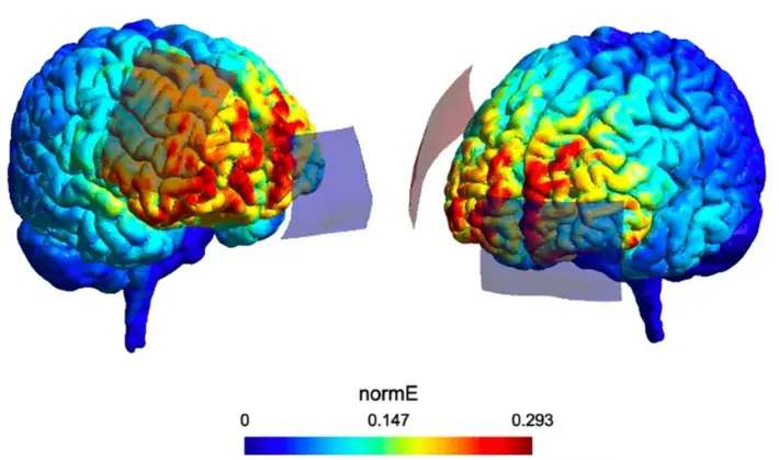 Distribución simulada del campo eléctrico sobre un modelo cerebral individual, en vistas izquierda y derecha